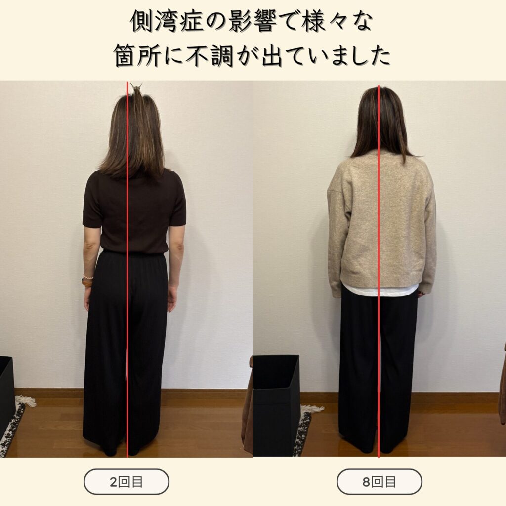 側湾症の影響でバランスが悪く右肩甲骨・肩・首筋の痛み・腰痛などで辛い思いをしてきました。施術を受けてから動きやすく生活がしやすくなりました！