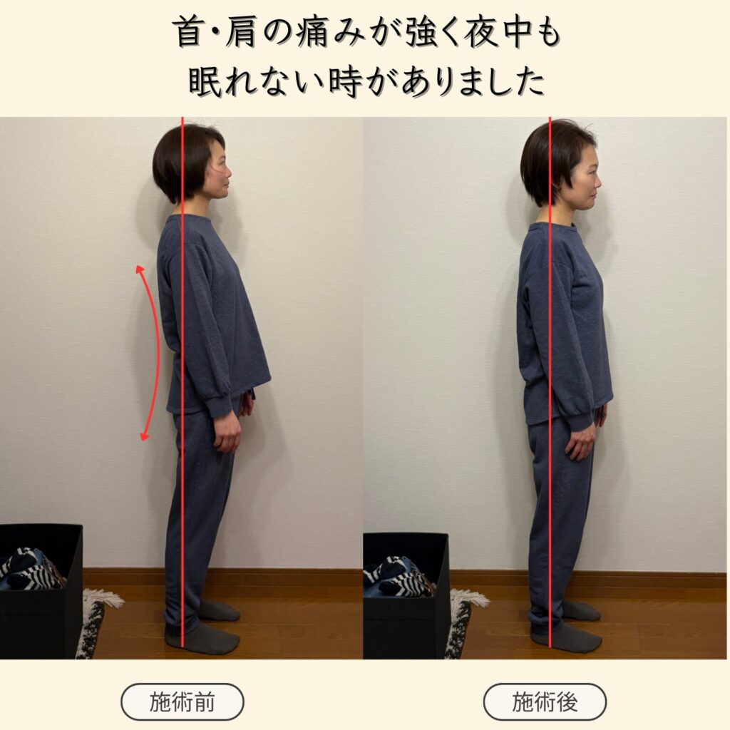 首・肩が痛くて寝るのも辛かったのが施術を受けた翌日から1週間ほど経ちますが痛みや痺れも無く快適に過ごせています。