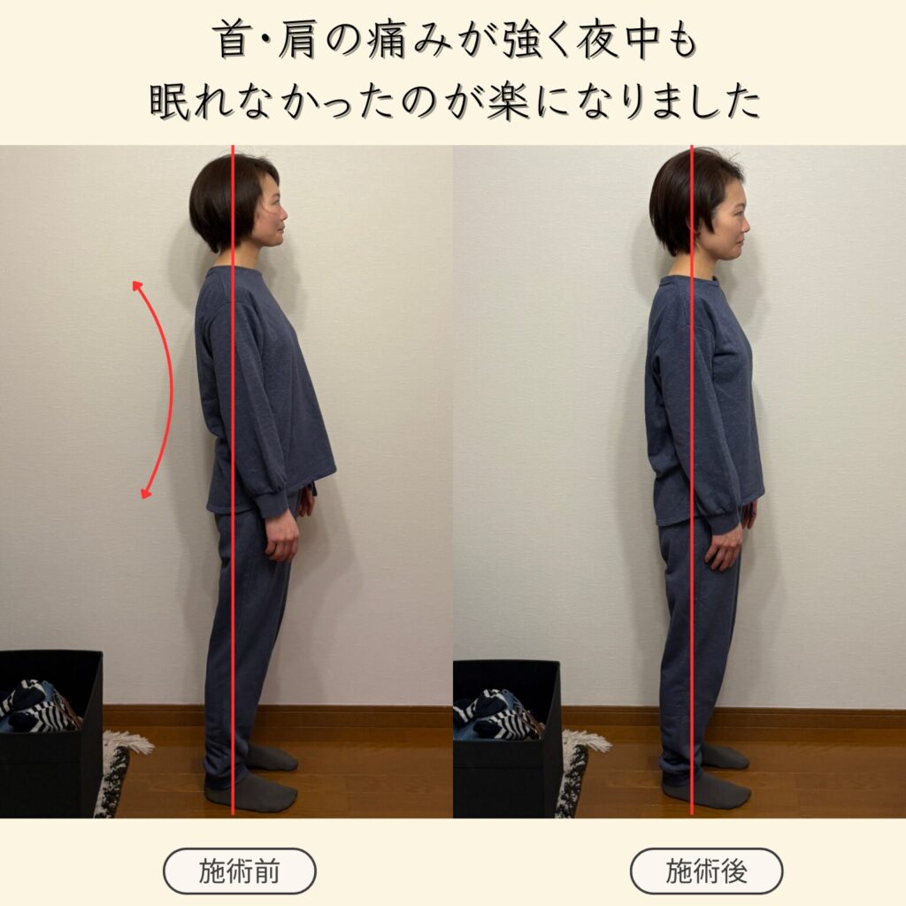 首・肩が痛くて寝るのも辛かったのが施術を受けた翌日から1週間ほど経ちますが痛みや痺れも無く快適に過ごせています。