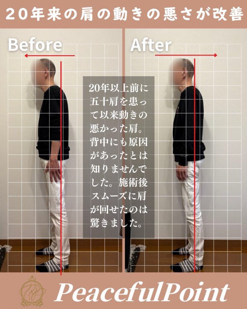 25年近く前に五十肩になって以来肩の動きも悪くなっていました。でも、施術を受けて本来自分の肩ってこんなに動くのかとびっくりしました。猫背姿勢も改善されて、一緒に来ていた妻にも驚かれました。
