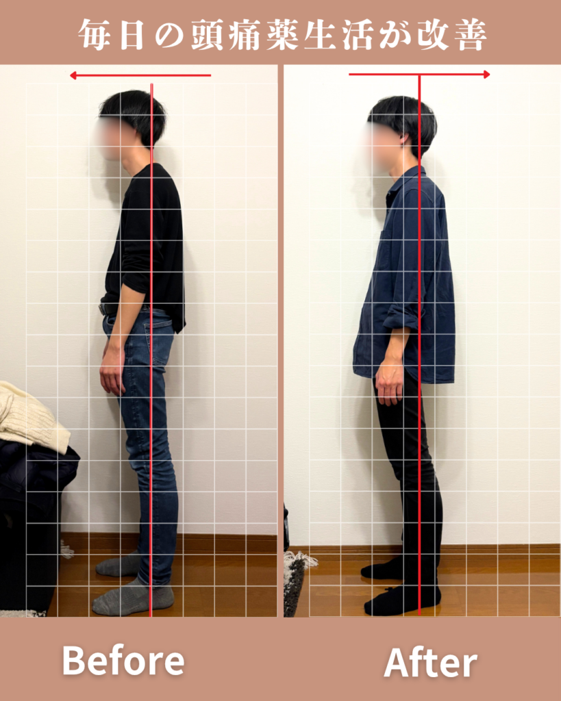 肩こりからの頭痛がありひどい時は毎日のように頭痛薬を飲んでいました。施術だけでなく日常のケアを教わり実践するうちに、頭痛も改善され今では薬を飲む機会がほぼなくなりました。