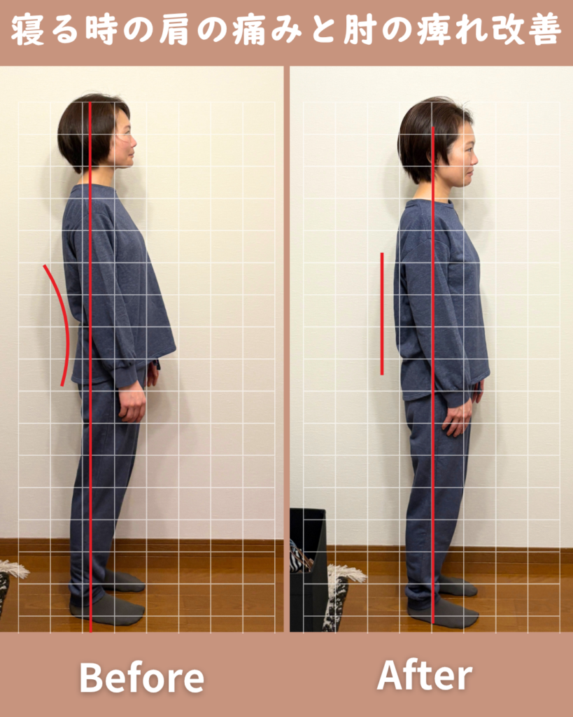 仕事の影響でいつも肩がこっていまいした。また、首の辺りから来る慢性的な手の痺れにも悩んでいました。寝る時が特に辛く毎日げんなりしていましたが、おかげさまで、今は痛みや痺れもなく毎日の晩酌も楽しめるまでに回復しました（笑）