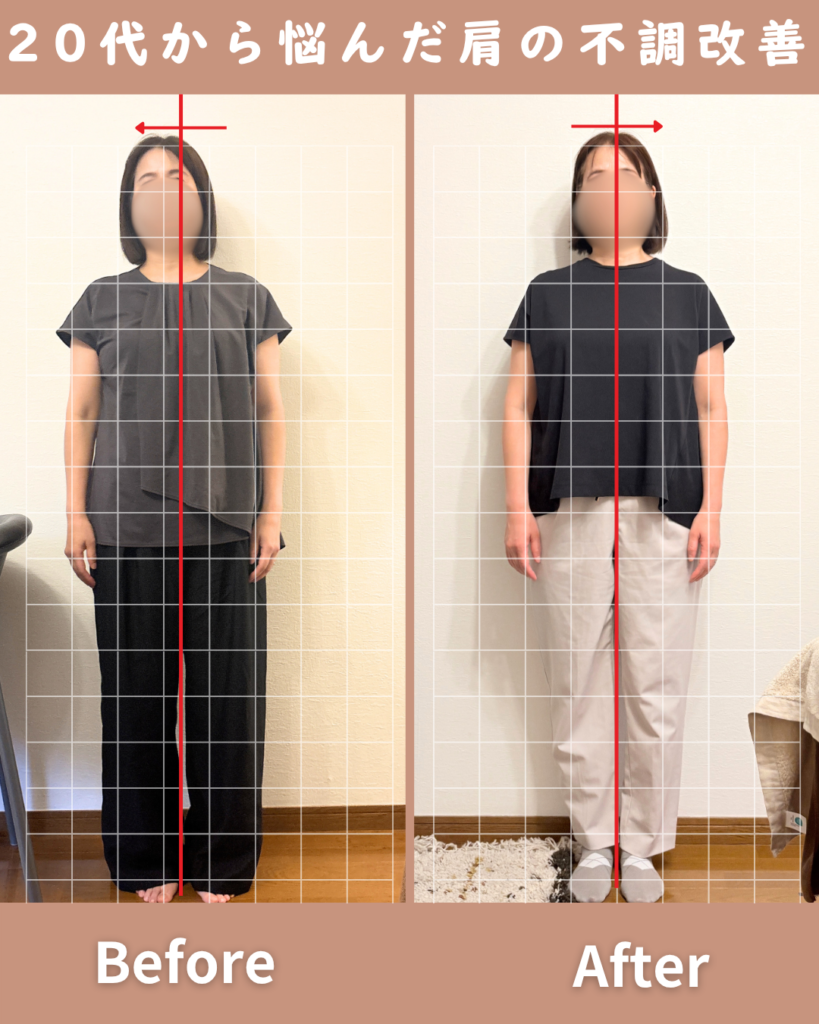 正直左肩の痛みは諦めていました。
背中にファスナーのある服を着替えるような時に、いつも肩をかばっていました。それが、通う度に改善していき、今では日常生活に支障がなくなり、避けていたような服も気にせず着られるので嬉しいです！
