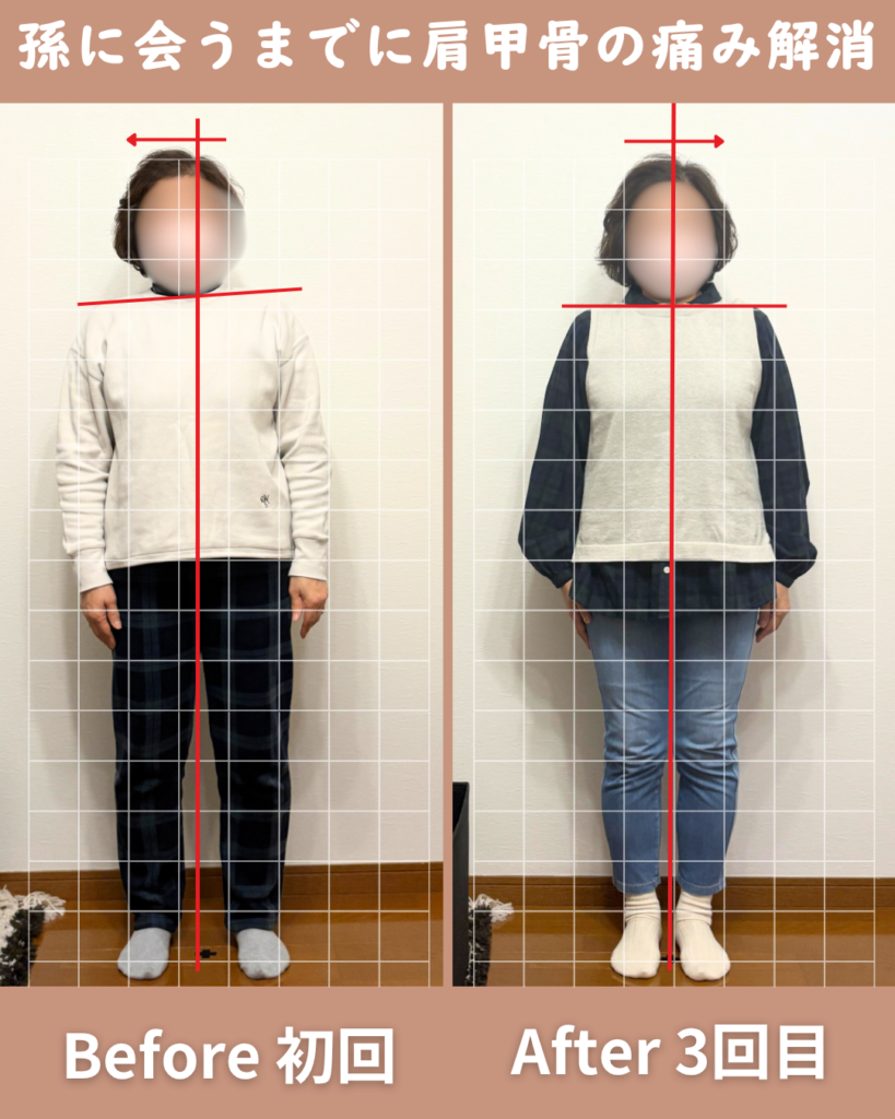 庭のお手入れを頑張りすぎて急に肩甲骨あたりに今までにない痛みが出ました。初めて来た時は、その１ヶ月後に孫の元に遊びに行く予定があったので心配でしたが、おかげ様でそれまでに痛みもなくなり無事に孫とも会うことができました。